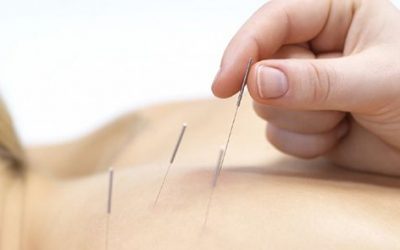 Punción seca para tratar dolores musculares